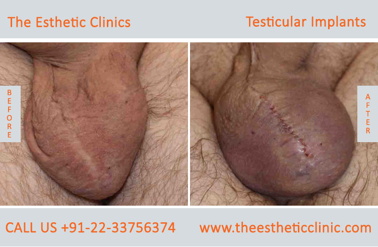 Testicular Implant surgery before after photos in mumbai india (1)